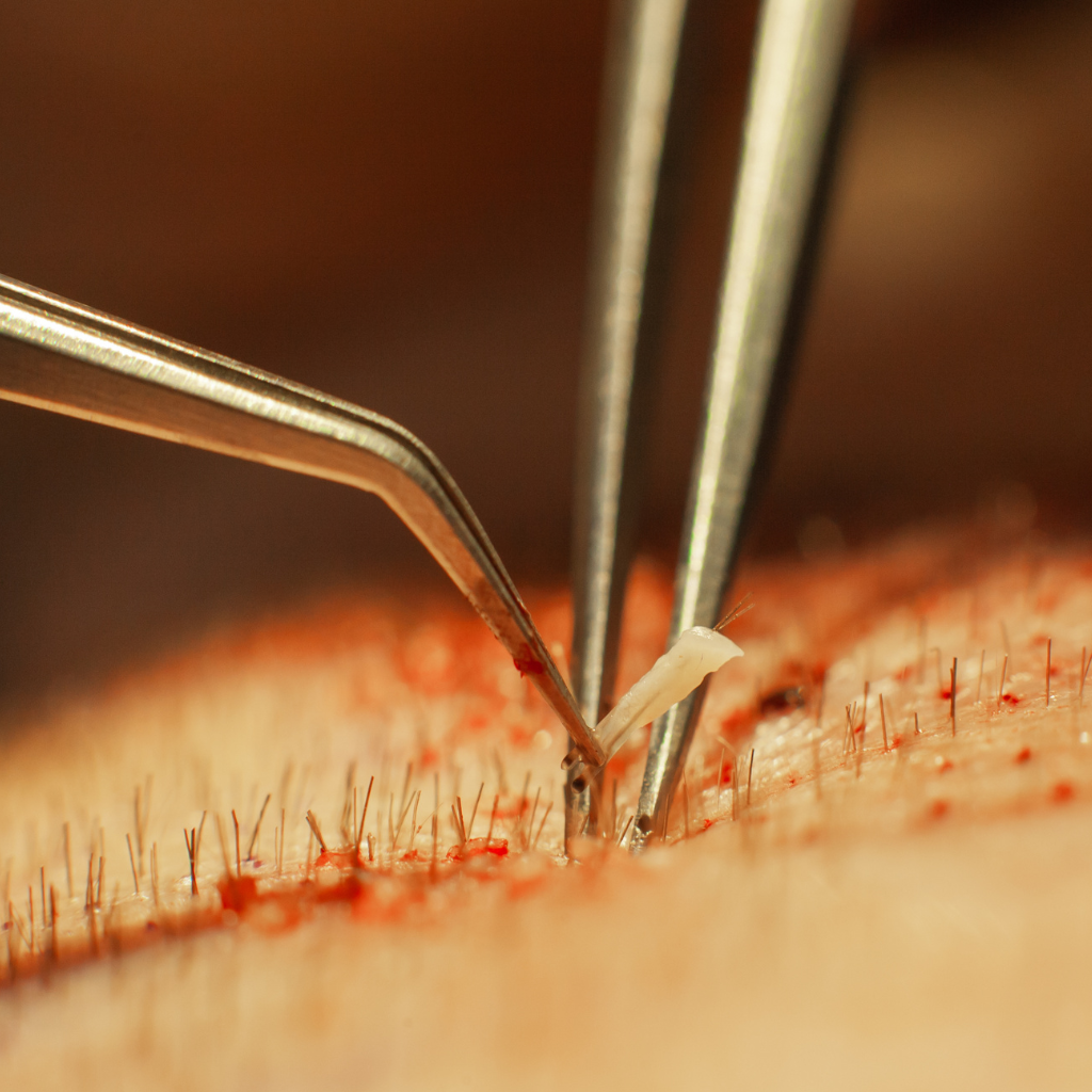 FUE Hair transplant